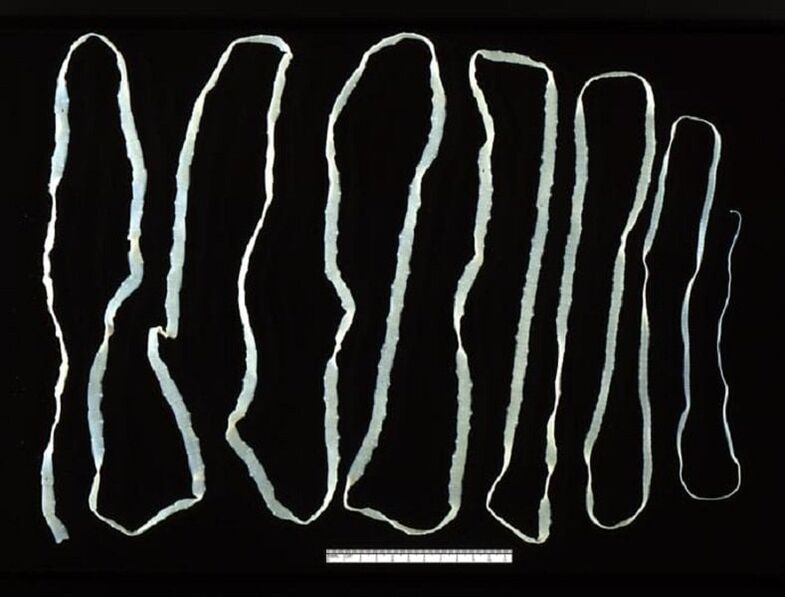 Trakavica izvađena iz ljudskog crijeva