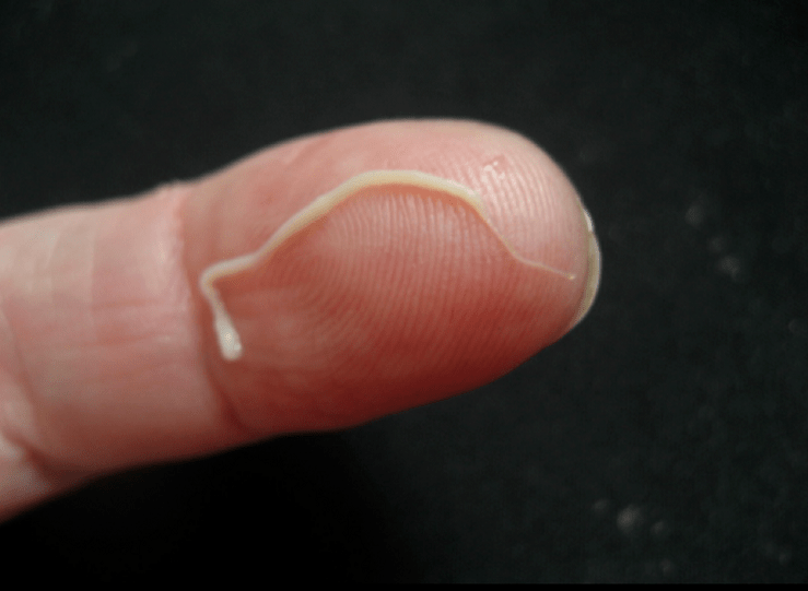 okrugli parazit iz ljudskog tijela